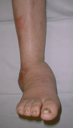 Charcot-Fu&szlig;, Ulcus am Au&szlig;enkn&ouml;chel